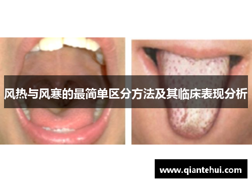 风热与风寒的最简单区分方法及其临床表现分析